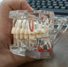 Dental Teeth Model Brackets Study Implant Pathological Disease Restoration Teach