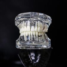 Dental Model Teeth Implant Restoration Bridge Teaching Study Dentist Dentistry