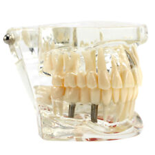 Dental Implant And Restoration Model Transparent Pathological Teeth Study Model
