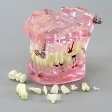 Dental Implant Teeth Model Teach Study Demo Restoration Pathology Bridge M2001