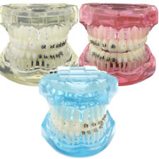 Dental Orthodontic Teeth Study Model With Metal Ceramic Bracket Braces 3003