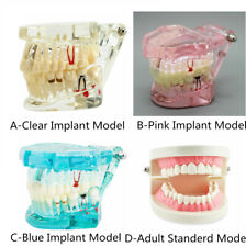 Dental Implant Teeth Model Disease Study Teaching Restoration Bridge Tooth Analy
