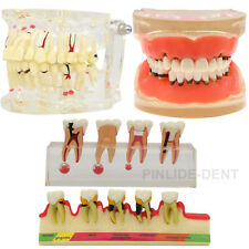 Dental Pathological Typodont Periodonticsimplantendodontic Caries Teeth Model
