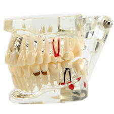 Dental Study Teach Implant Teeth Model Restoration Bridge Caries Denture Educate