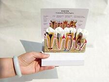 Anatomical Diseased Teeth And Gums Model Dental Hygiene Tooth Medical Anatomy Us