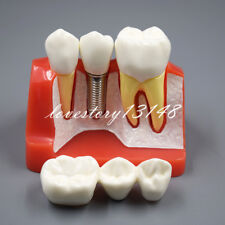 Dental Demonstration Teeth Model Implant Analysis Crown Bridge For Dentist High