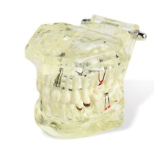 New Listingdental Implant Disease Teeth Model With Restoration Bridge Tooth Denshine