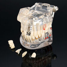 Dental Implant Disease Study Teaching Teeth Model With Restorationampbridge Tooth