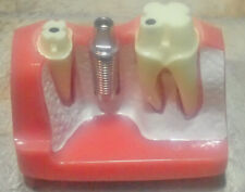 Dental Teeth Model Implant Analysis Study Crown Root Removable Demonstration