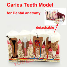 Dental Anatomy Detachable Caries Plastic Teeth Anatomical Model Demonstration