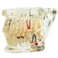 Dental Implant Disease Model Teach Study Oral Teeth Bridge Restoration Pathology