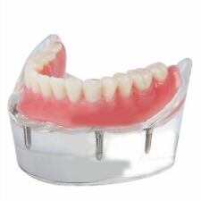 Ce Dental Implant Restoration Teeth Model Removable Inferior With 4 Implants