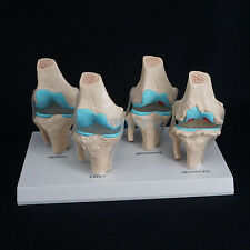 Anatomical Human Degenerative Knee Joint Disease Model Medical Skeleton Anatomy
