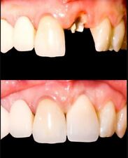 Natural Shade Or Bright Shade Temporary Tooth Kit Temp Replace Missing Diy