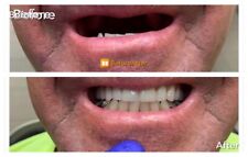 Denture Partials Partial Dentures