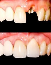 Temporary Tooth Kit Temp Repair Replace Missing Diy Safe Easy Video Link Teeth