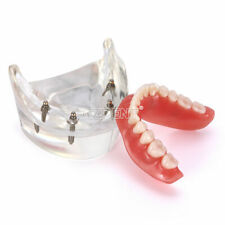 Dental Implant Teeth Model Demo Overdenture Restoration With 4lower Implants